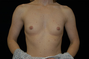 Breast Augmentation 13a